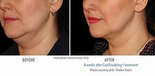 Image result for Chin Sculpting