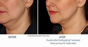 Image result for CoolSculpting On Double Chin