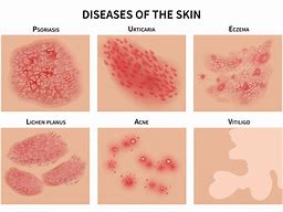 Image result for Common Skin Diseases Humans