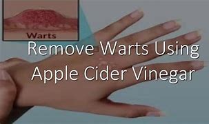 Image result for Genital Wart Removal Apple Cider Vinegar