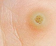 Image result for Pictures of Molluscum Contagiosum