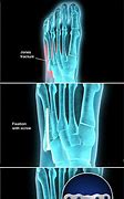 Image result for Jones Fracture Foot Surgery