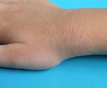 Image result for What Does Mild Eczema Look Like