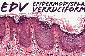 Image result for Epidermodysplasia Verruciformis Groin