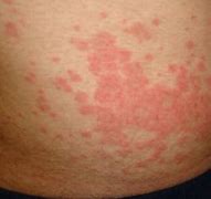 Image result for Maculopapular Rashes