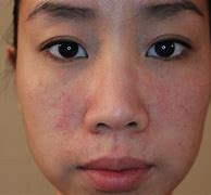 Image result for Allergic Skin Reactions On Face