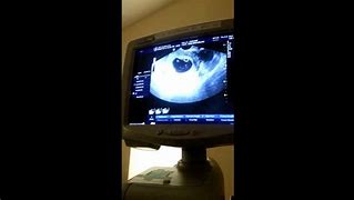 Image result for 9 Weeks 5 Days Ultrasound