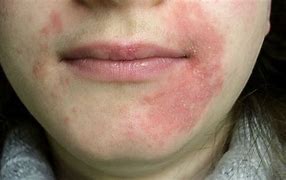 Image result for Rash around Mouth That Burns