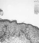 Image result for Squamous Cell Papilloma Gross Specimen