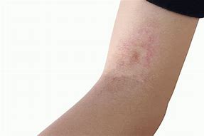 Image result for Fungal Infection On Arm