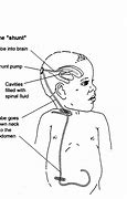 Image result for Hydrocephalus Signs