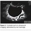 Image result for Ovarian Cyst Types