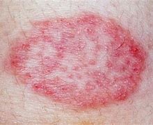 Image result for Leukemia Skin Symptoms