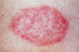 Image result for Leukemia Red Spots