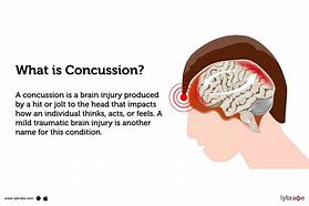 Image result for Concussion