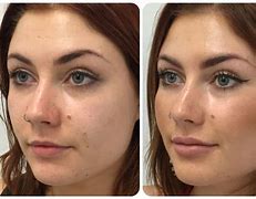 Image result for Cheek Augmentation