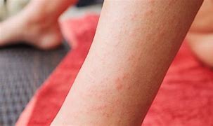 Image result for Benadryl Allergic Reaction Rash