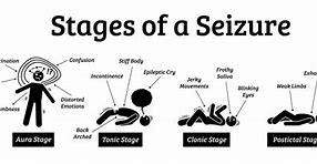 Image result for Arms Straight Out Seizure