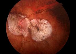 Image result for Maculopathy Double Vision