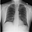 bronchopneumonia 的图像结果