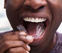 Image result for What Are Invisalign Braces
