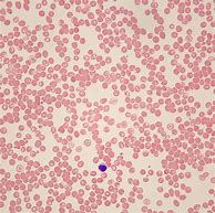 Image result for Sickle Cell Trait Blood Smear