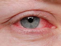 Image result for Fungal Eye Infection
