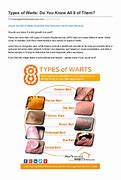 Image result for Different Types of Warts