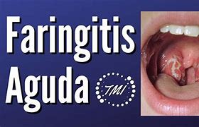 Image result for amigdalitis