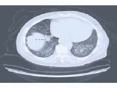 Image result for Right Lower Lobe Lung Nodule