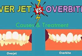 Image result for Overjet and Overbite Definition