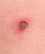 Image result for Tick Biting