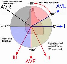 Image result for Heart Axis Deviation