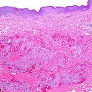Image result for Kaposi Sarcoma Patch Stage