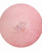 Image result for Skin Virus Molluscum