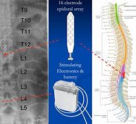 Image result for Transcutaneous Electrical Nerve Stimulation