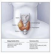 Image result for Thyroid Nodule 2 Cm