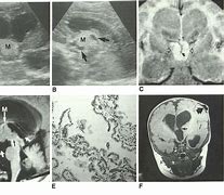 Image result for Choroid Plexus Papilloma 3rd Vrentricle