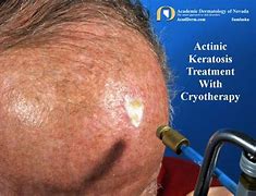 Image result for Cryotherapy Skin Lesion