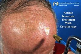 Image result for Actinic Keratosis Cryotherapy