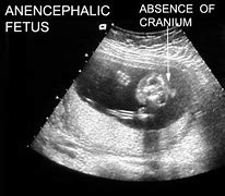 Image result for Anencephaly at 20 Years
