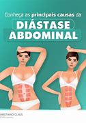 Image result for Diastase Do Musculo Reto Abdominal Homem