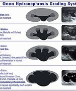 Image result for 2Cm Dilated First Baby