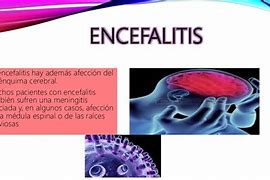 Image result for encefalitis
