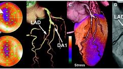 Image result for Cardiac MRI Stress Test