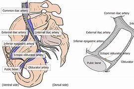 Image result for corona_mortis