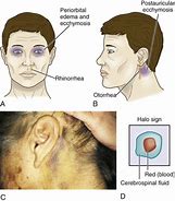 Image result for Normal Morphology of CSF