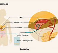 Image result for External Biliary Drain