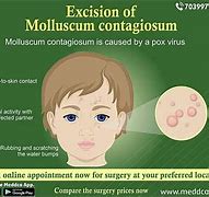 Image result for Molluscum Contagiosum On Face