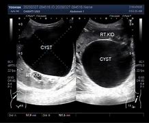 Image result for Large Renal Cyst